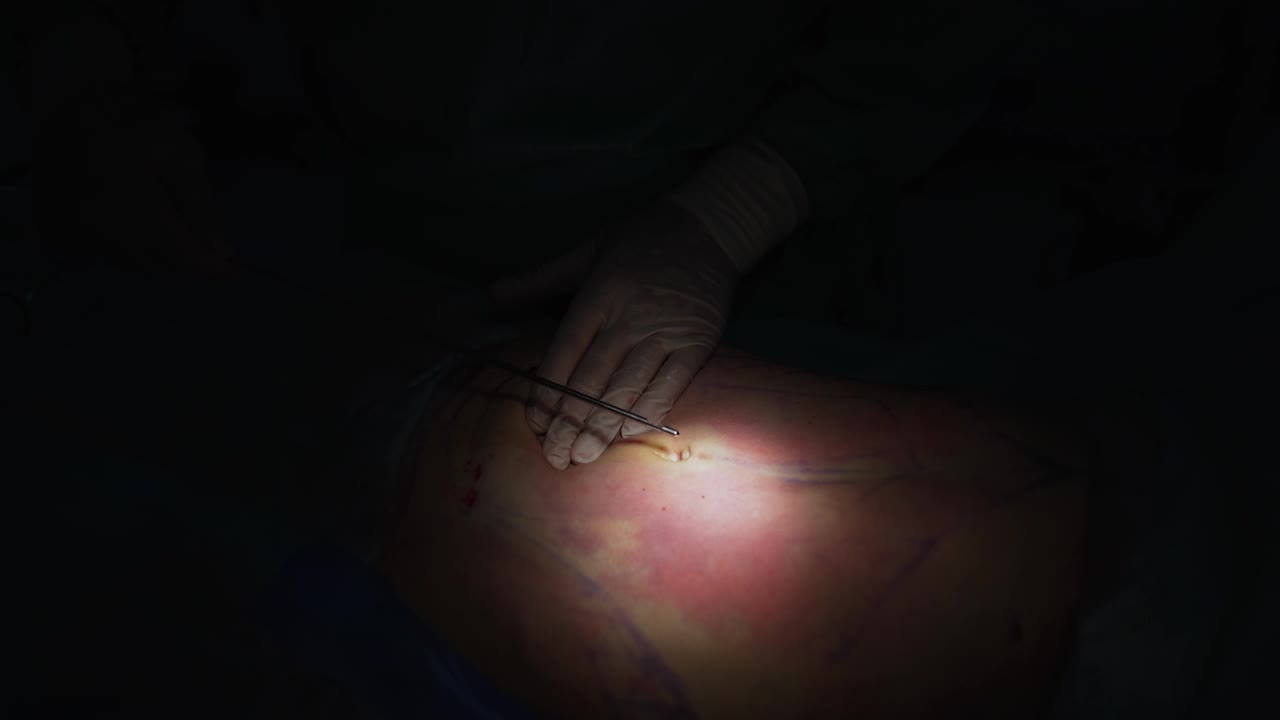 脂肪切除手术。抽脂过程中医生的手放在病人腹部。详细的手术过程。特写镜头。视频下载