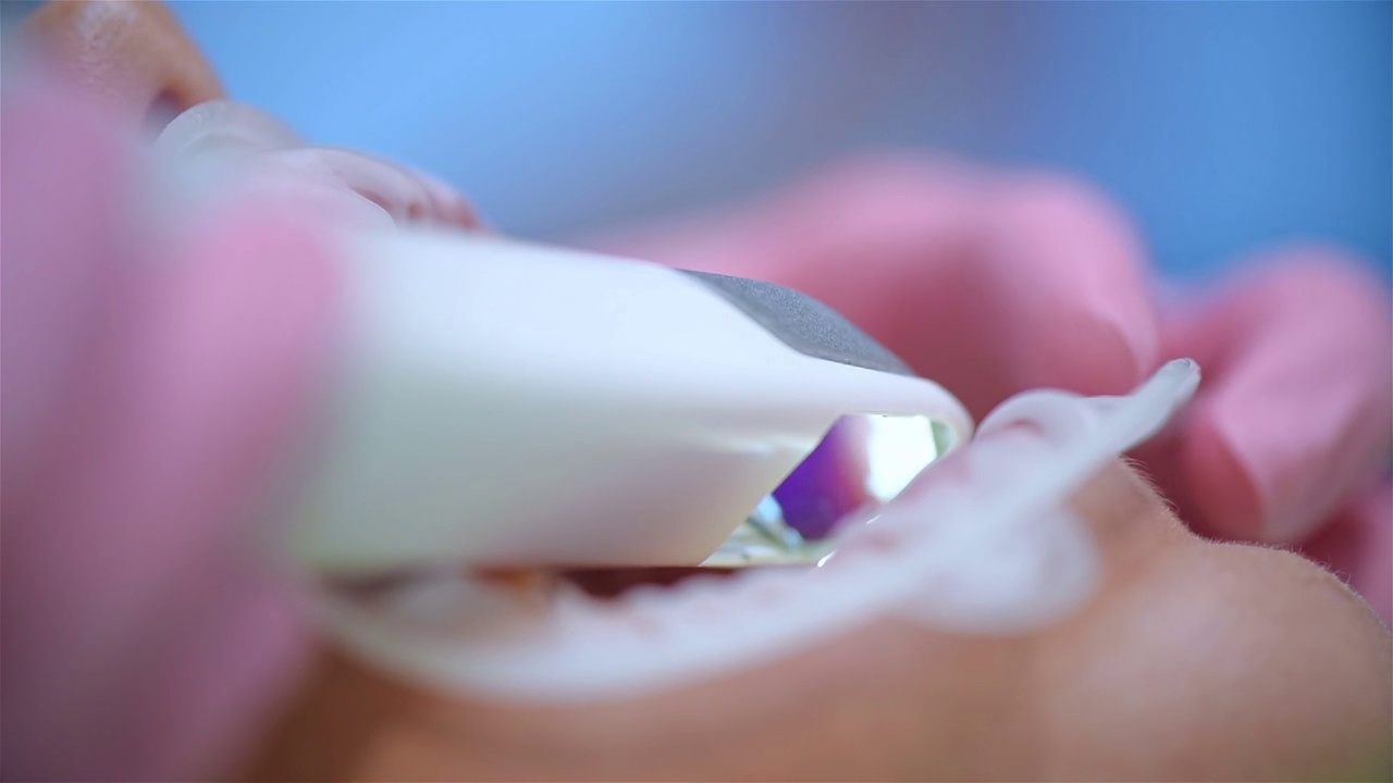 戴粉色手套的正畸医生用口腔内扫描仪扫描病人。视频下载