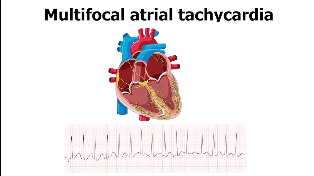 心电图显示心律失常，多灶性房性心动过速(MAT)伴心脏跳动视频素材