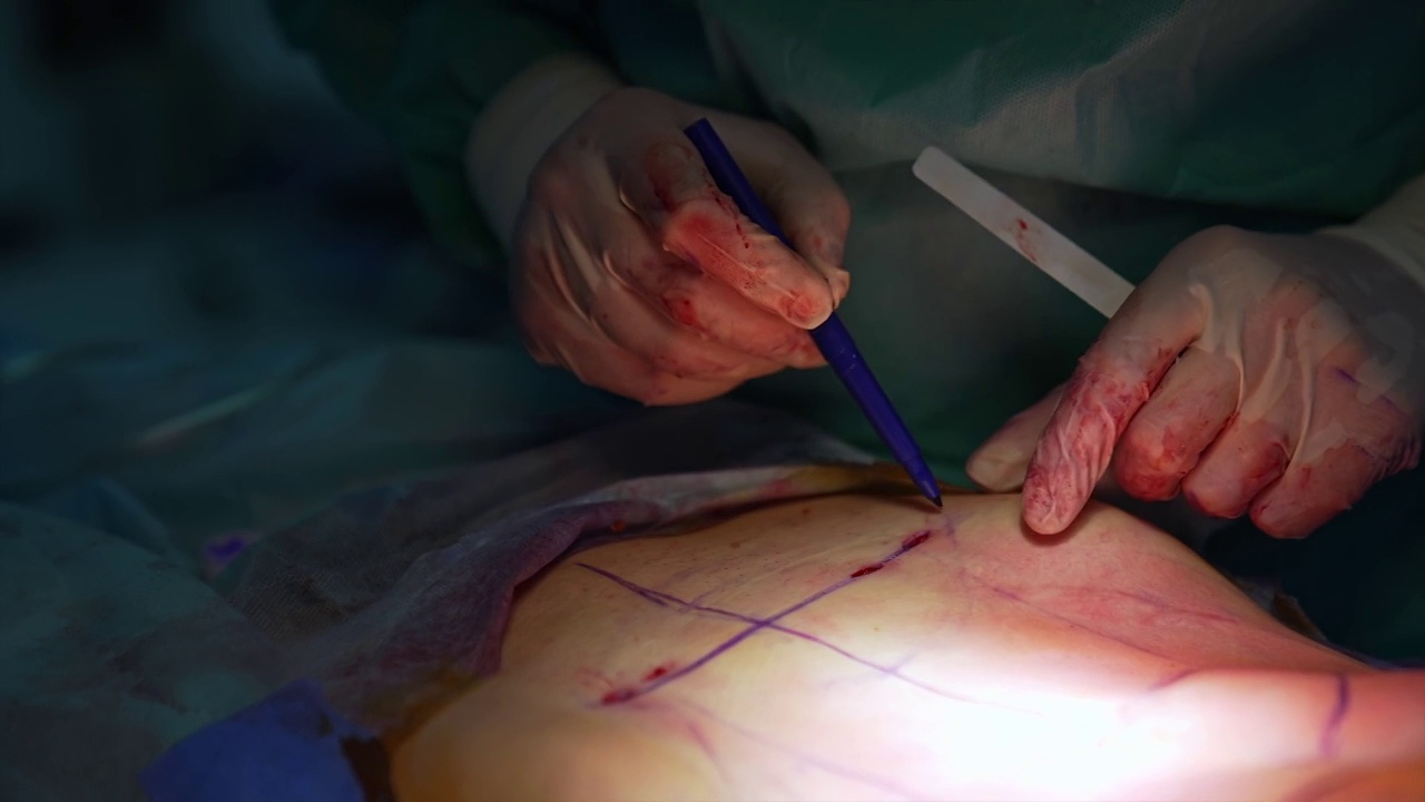 医生用记号笔在病人腹部画线。外科医生将有问题的部位标记在腹部，以便进一步抽脂。特写镜头。视频下载