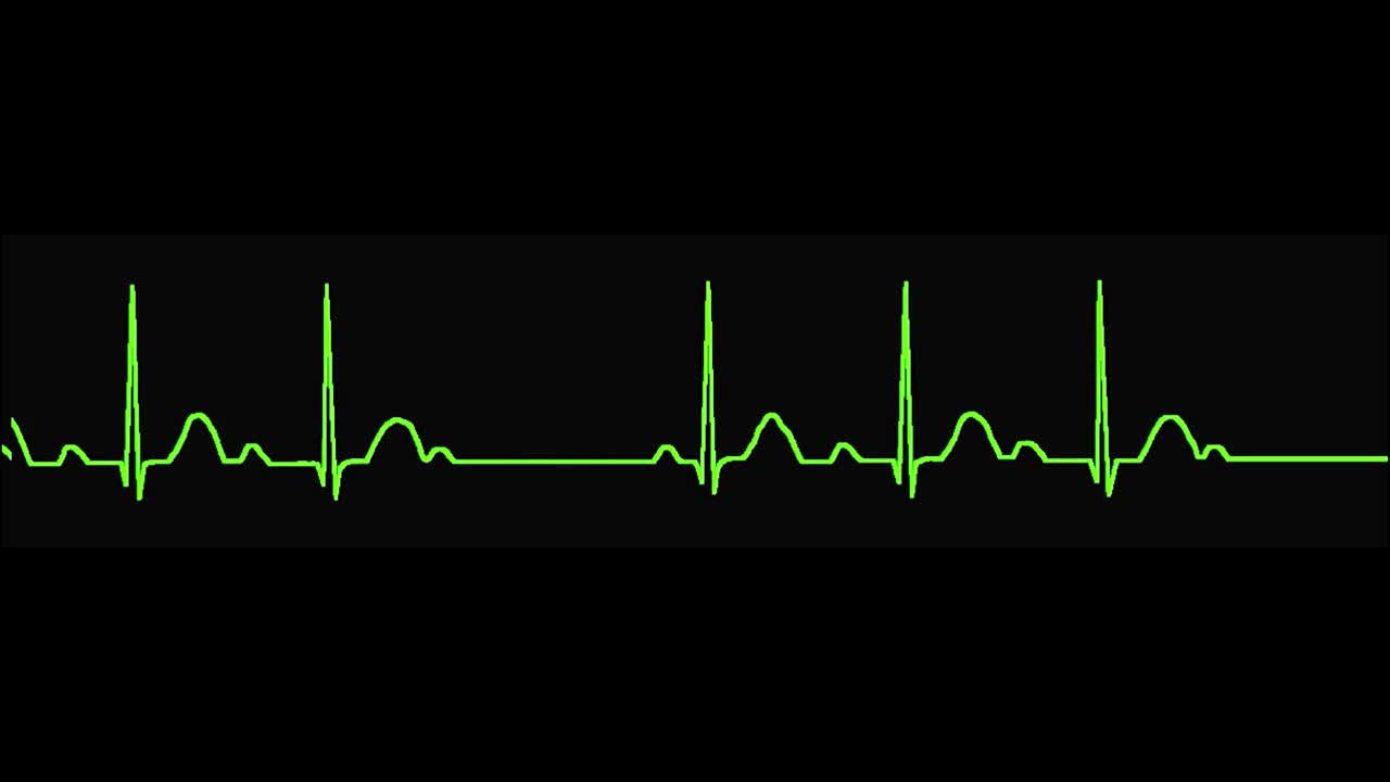 心电图显示二级心律不齐视频素材