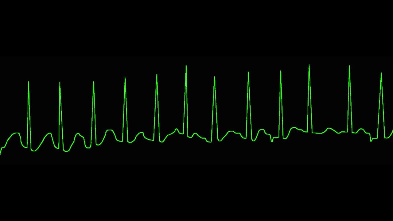 心电图显示多灶性房性心动过速(MAT)视频素材