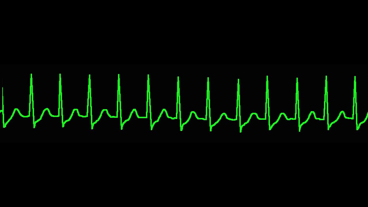 心电图显示阵发性室上性心动过速(PSVT/SVT)视频素材