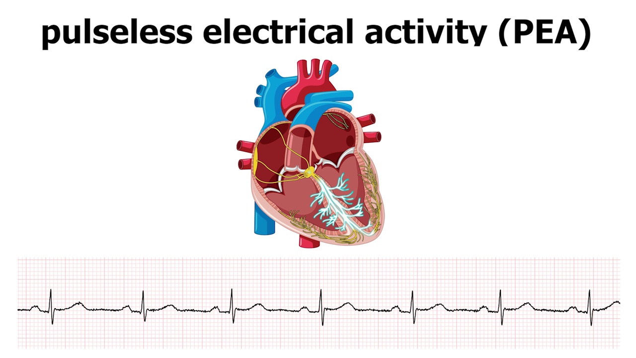 基于心电活动(PEA)的心脏动画视频素材