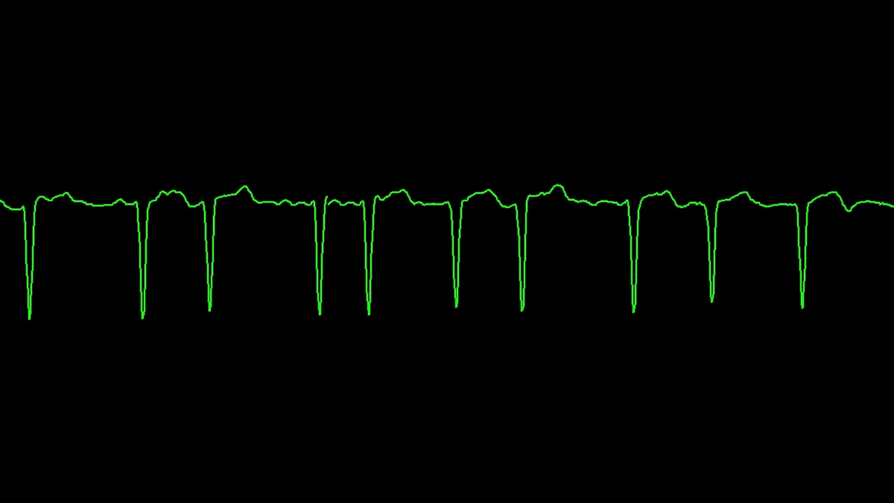 心电图显示心房颤动、心律失常视频素材