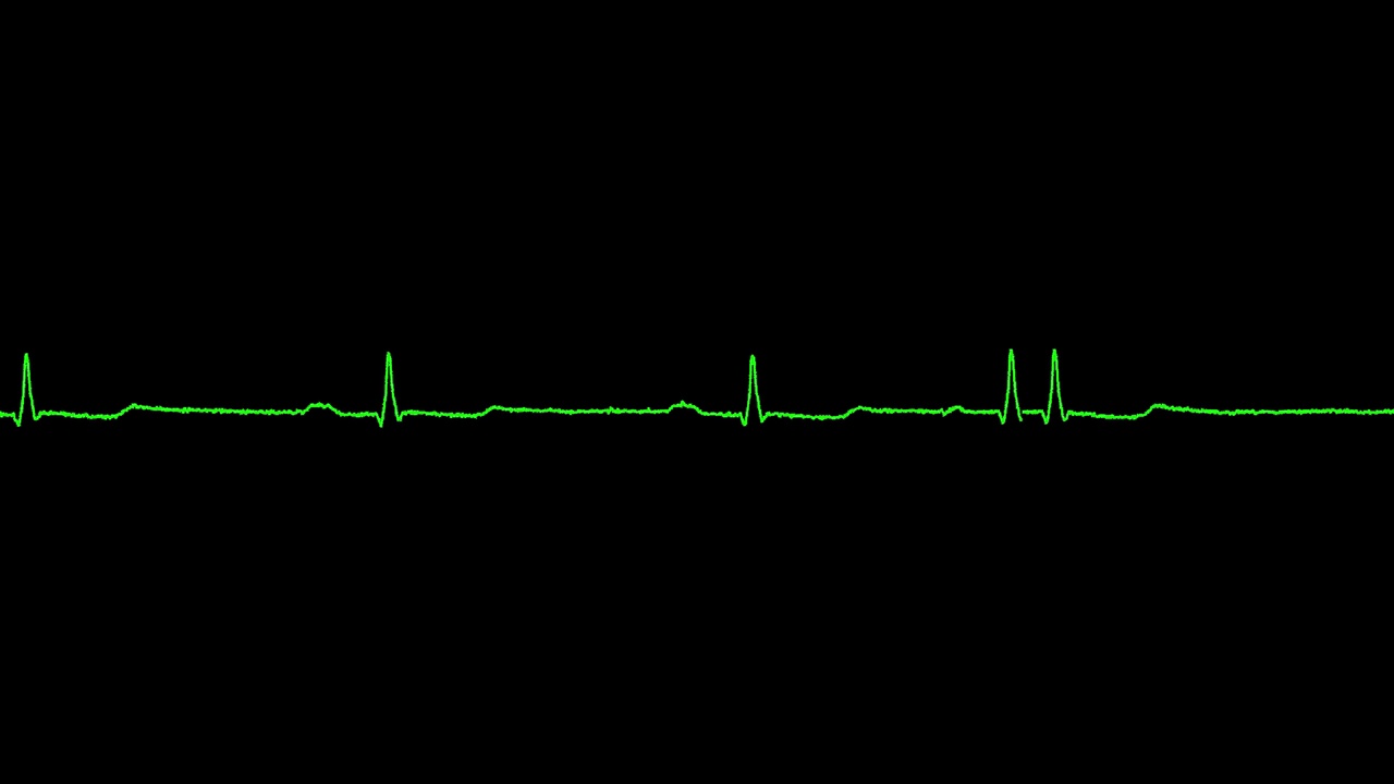 心电图显示窦性心动过缓视频素材
