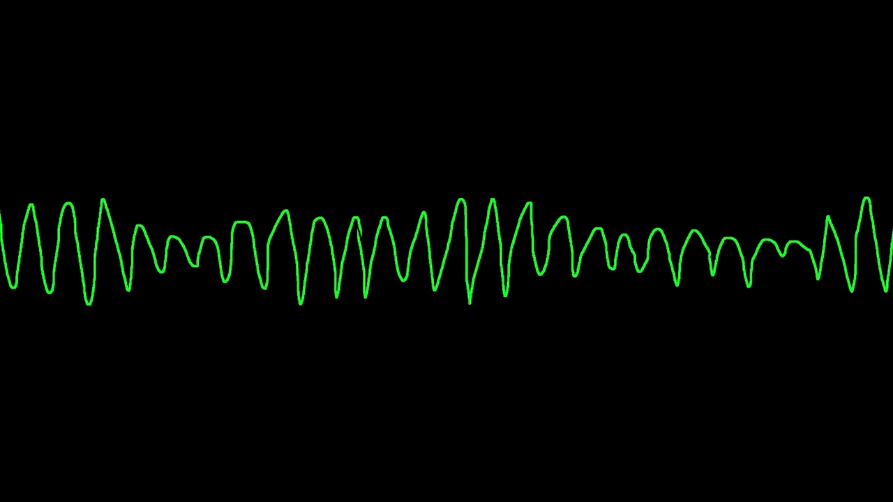 心电图显示心尖扭转(TDP)视频素材