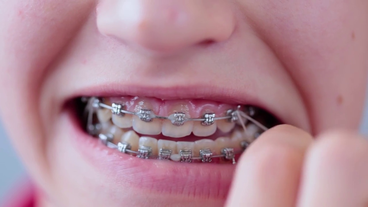 女孩在牙套上橡皮筋，以获得完美的微笑视频下载