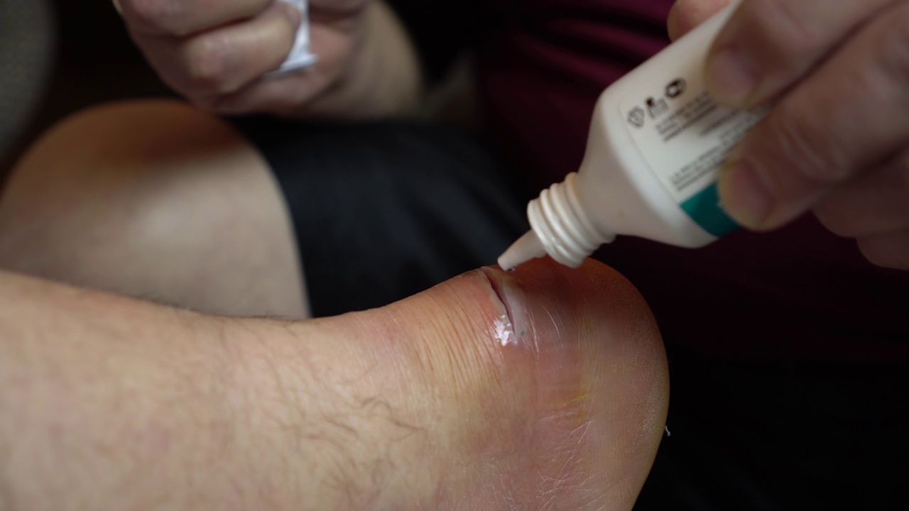 用杀菌剂治疗腿部伤口踝关节发炎导致手术切口。视频下载