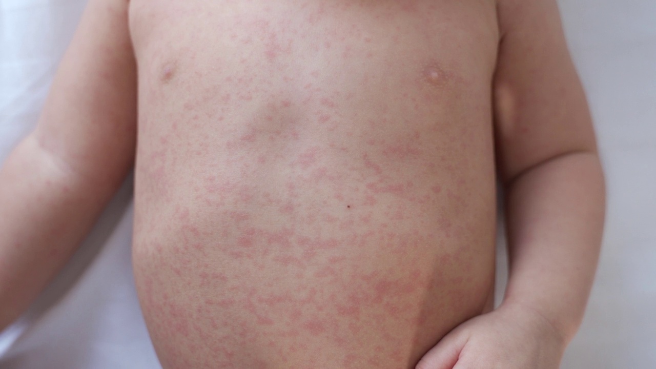 蹒跚学步的婴儿在身上刮出水痘疹。儿童红疹过敏。关闭发烧疹子。视频下载