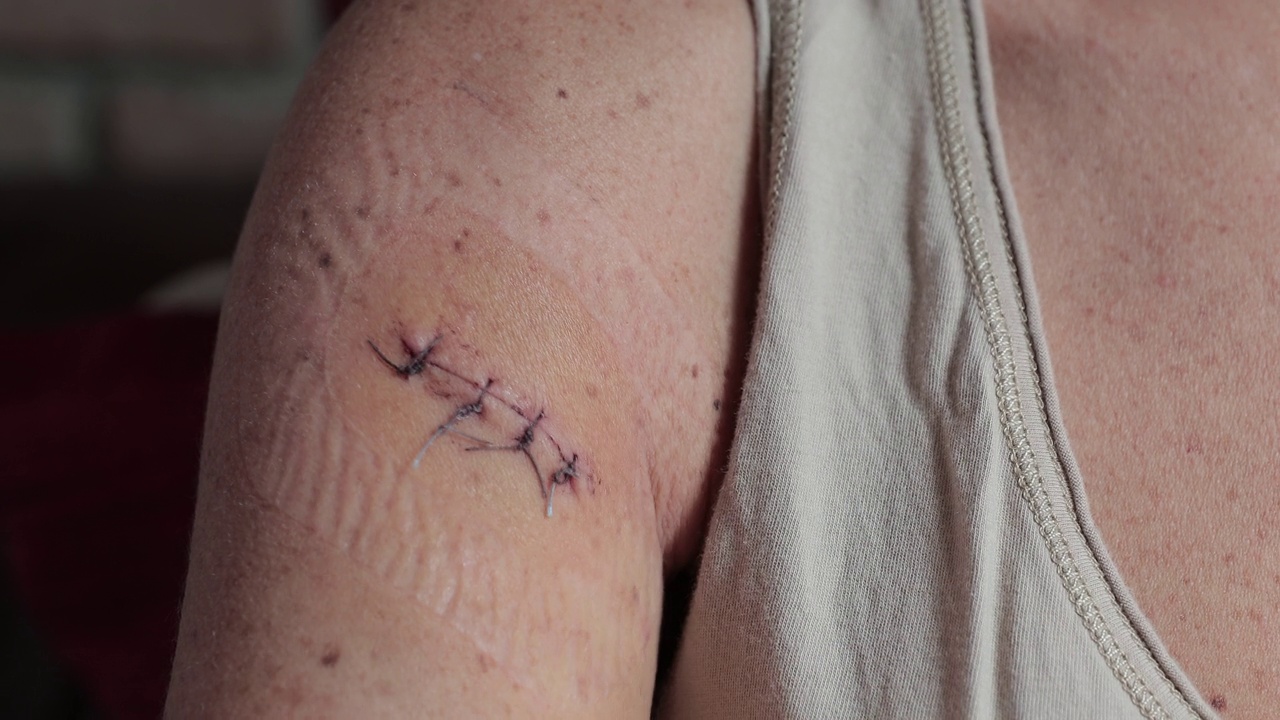 一名妇女正在取出手臂上缝合的伤口，以便进行家庭治疗视频素材