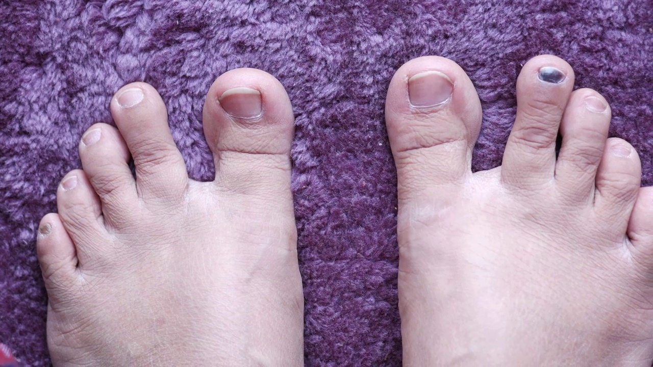 妇女受感染的脚和手指的特写视频下载