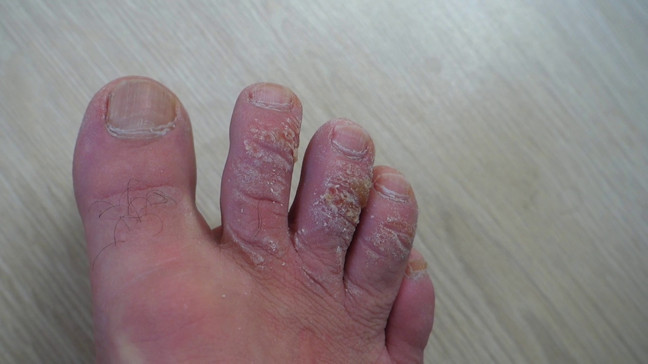 足部皮肤疾病，手指真菌形成，手指老茧，视频下载