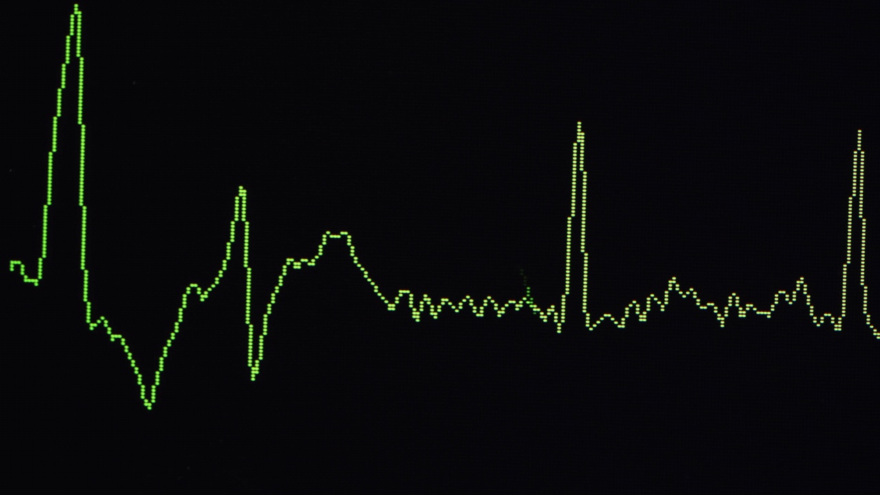 在个人使用(家庭使用)心电图上显示的心律失常心脏的心电图视频下载