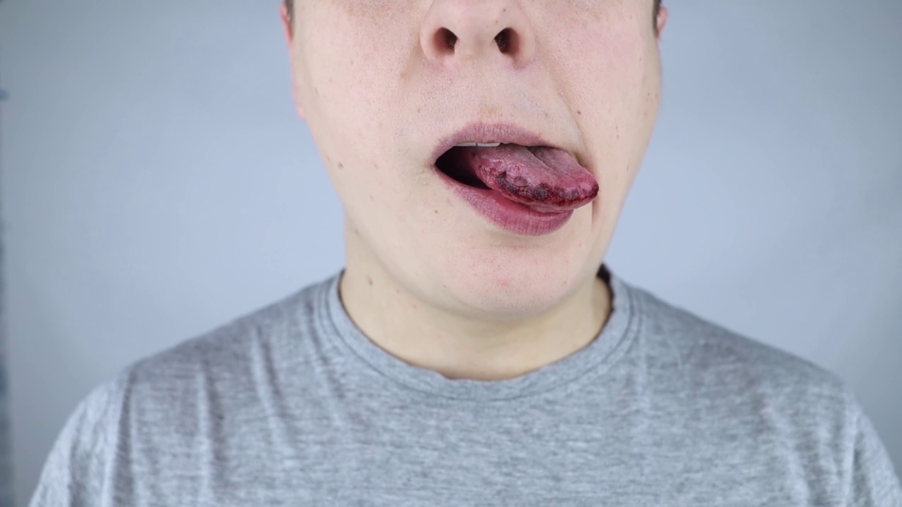 黑色的舌头。男人会展示舌头受伤、咬伤或烧伤的后果。部分损坏。内伤治疗视频下载