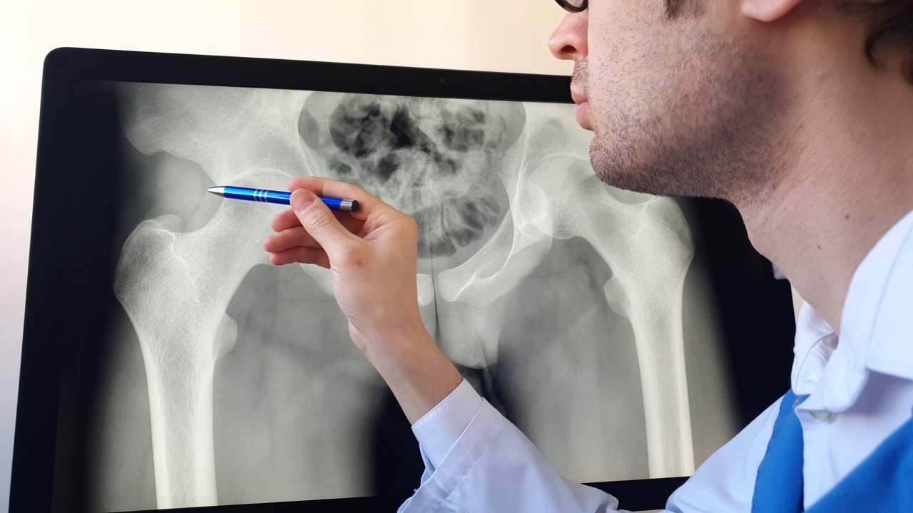 放射科医生在电脑上分析数字骨盆x光片。视频素材