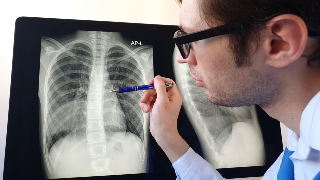 放射科医师分析右半胸肺肺炎胸片。视频素材