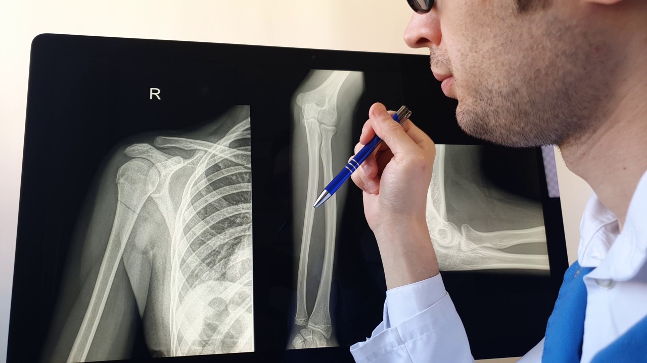 放射科医生分析肱骨骨折患者手臂和前臂骨x线片。视频素材
