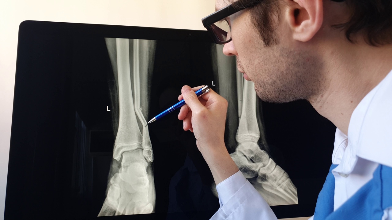 放射科医生分析一名足球运动员腓骨骨折的x光片。视频素材