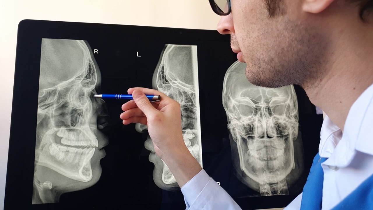 法医放射科医生在分析鼻骨骨折视频素材