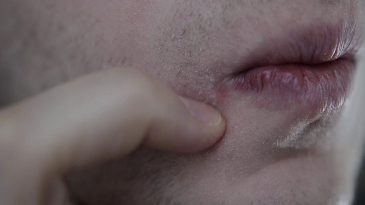 男人脸上有干燥的皮肤，嘴唇附近有一个丘疹。特写镜头视频素材