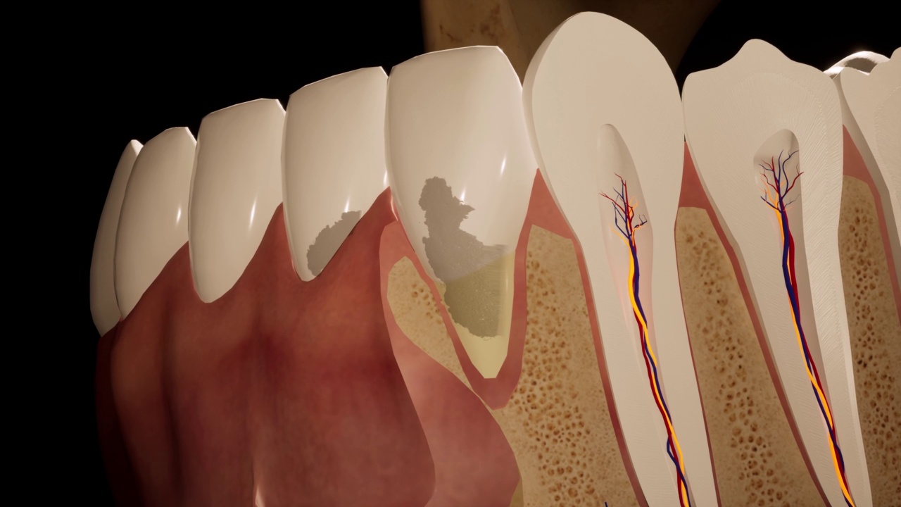 牙痛。牙齿解剖的详细切片。神经炎症。三维动画视频下载