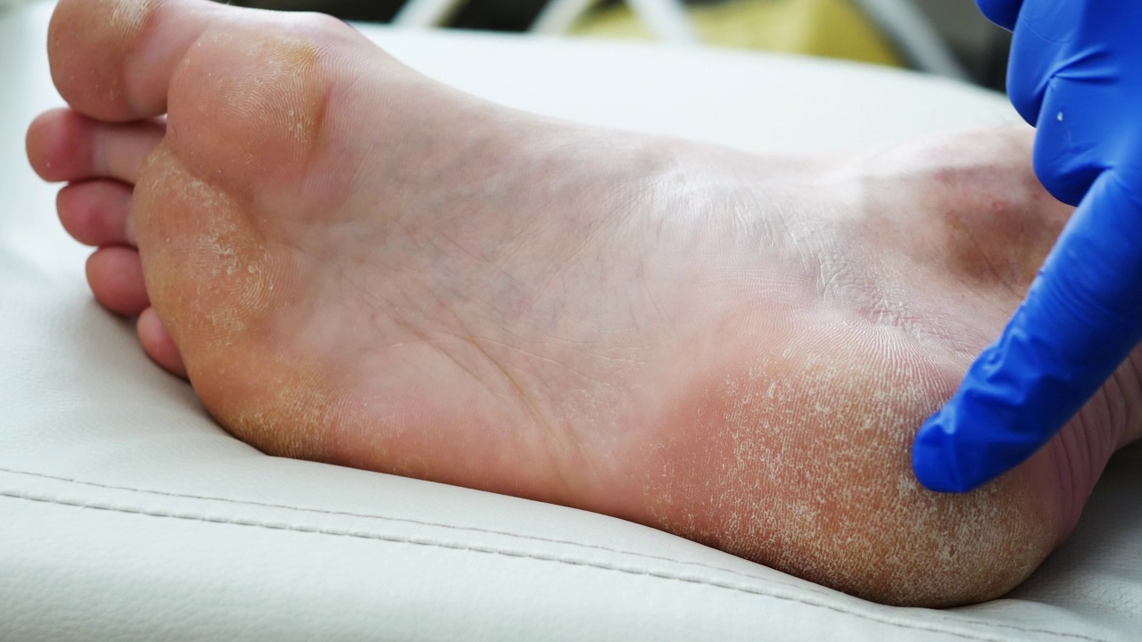 皮肤干燥，足部银屑病皮肤受损。皮炎、湿疹、牛皮癣、过敏反应。一个人脱皮和破裂的脚的特写。真菌感染或脚气，脚汗，或脱水。视频下载