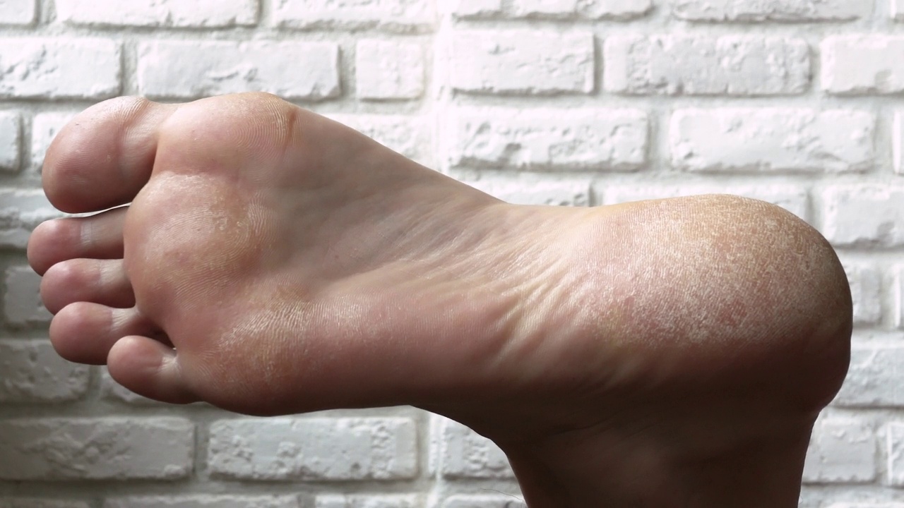皮肤干燥，足部银屑病皮肤受损。皮炎、湿疹、牛皮癣、过敏反应。一个人脱皮和破裂的脚的特写。真菌感染或香港脚。视频下载