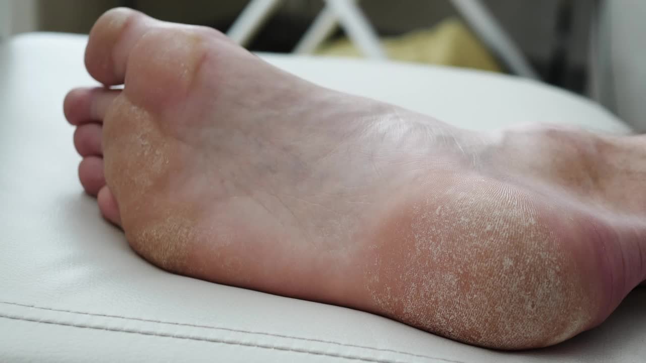 人类的脚。皮肤干燥，足部银屑病。皮肤受损。皮炎、湿疹、牛皮癣、过敏反应。特写-人的脚脱皮和开裂。真菌感染视频下载