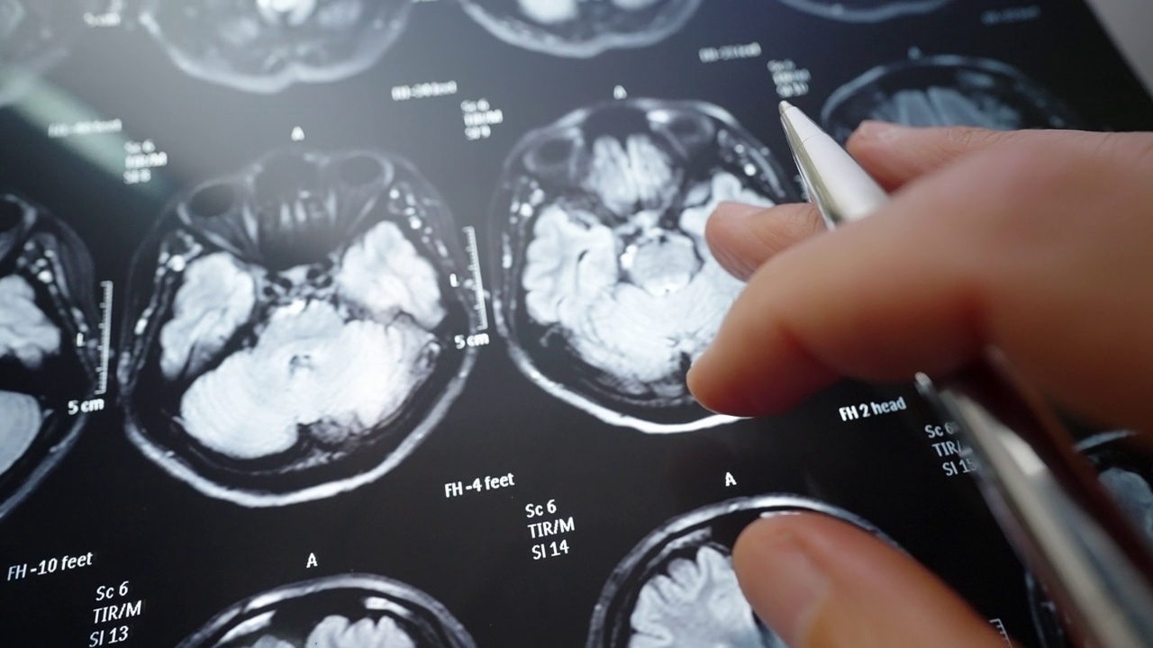 脑部核磁共振。扫描检查肿瘤或癌症。视频素材