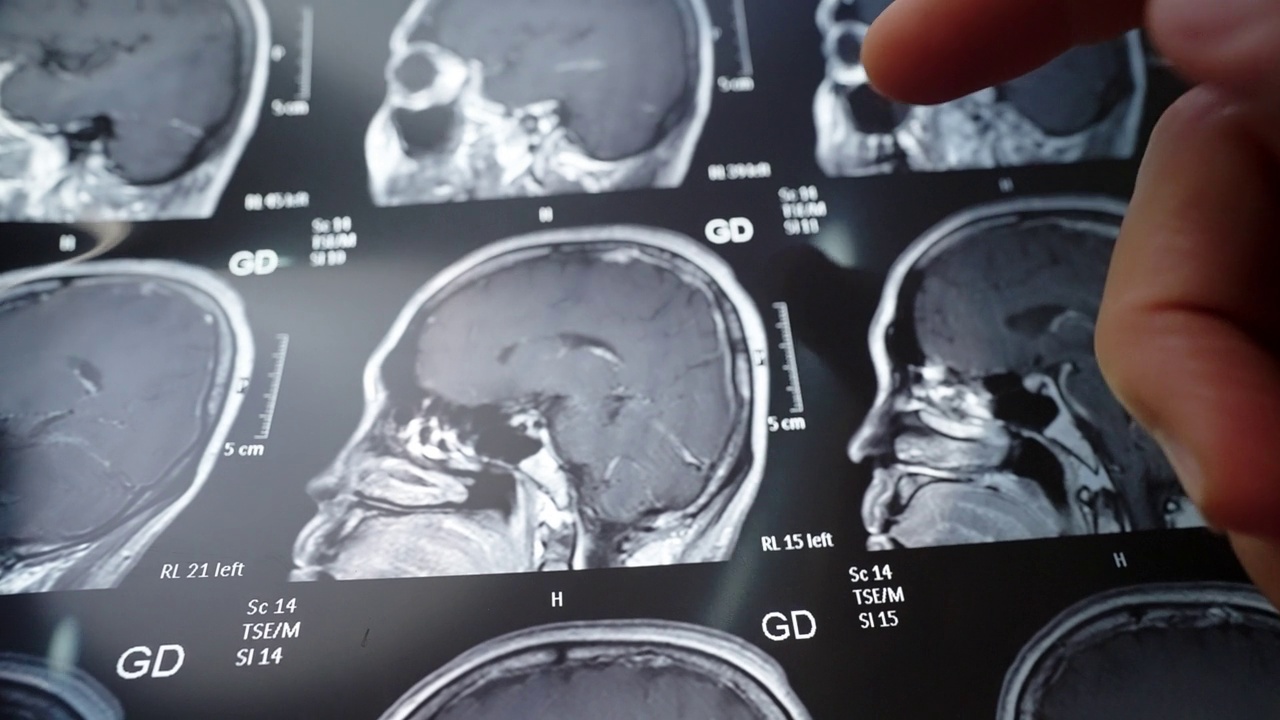 脑部核磁共振。扫描检查肿瘤或癌症。视频素材