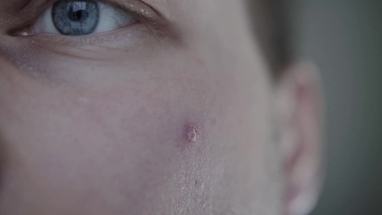一个男人的脸颊上有一个红色的干燥的丘疹。问题皮肤,皮肤视频素材