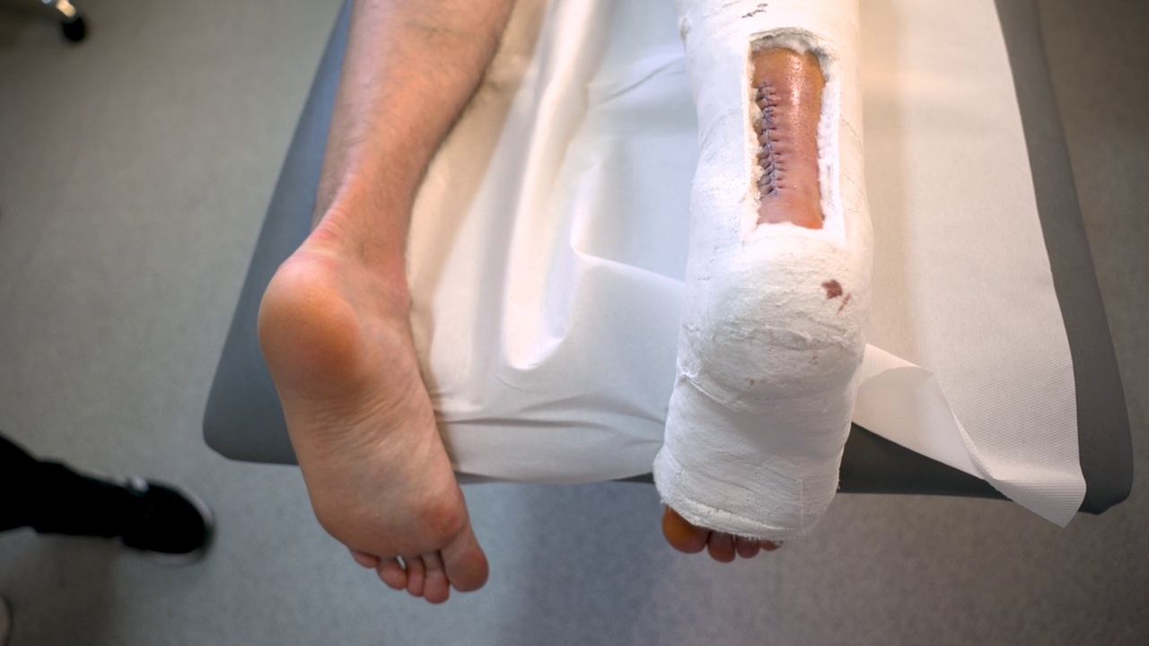 石膏腿上手术缝线的b型图视频下载