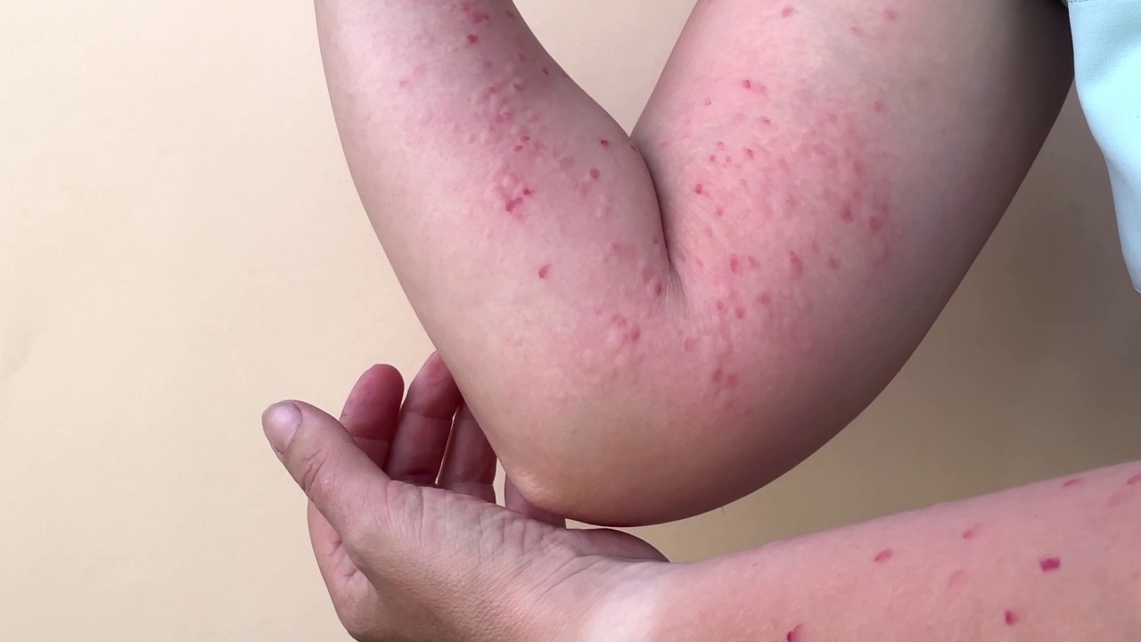 猴痘是一种危害全世界的新疾病。猴痘患者。疼痛的皮疹，红点，水泡在手。关闭皮疹，人类的手与健康问题。视频下载