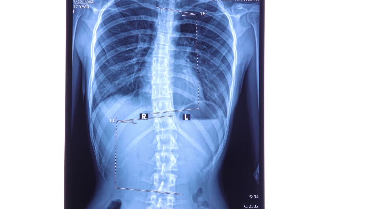 医生分析脊柱X线片显示腰椎侧弯视频素材
