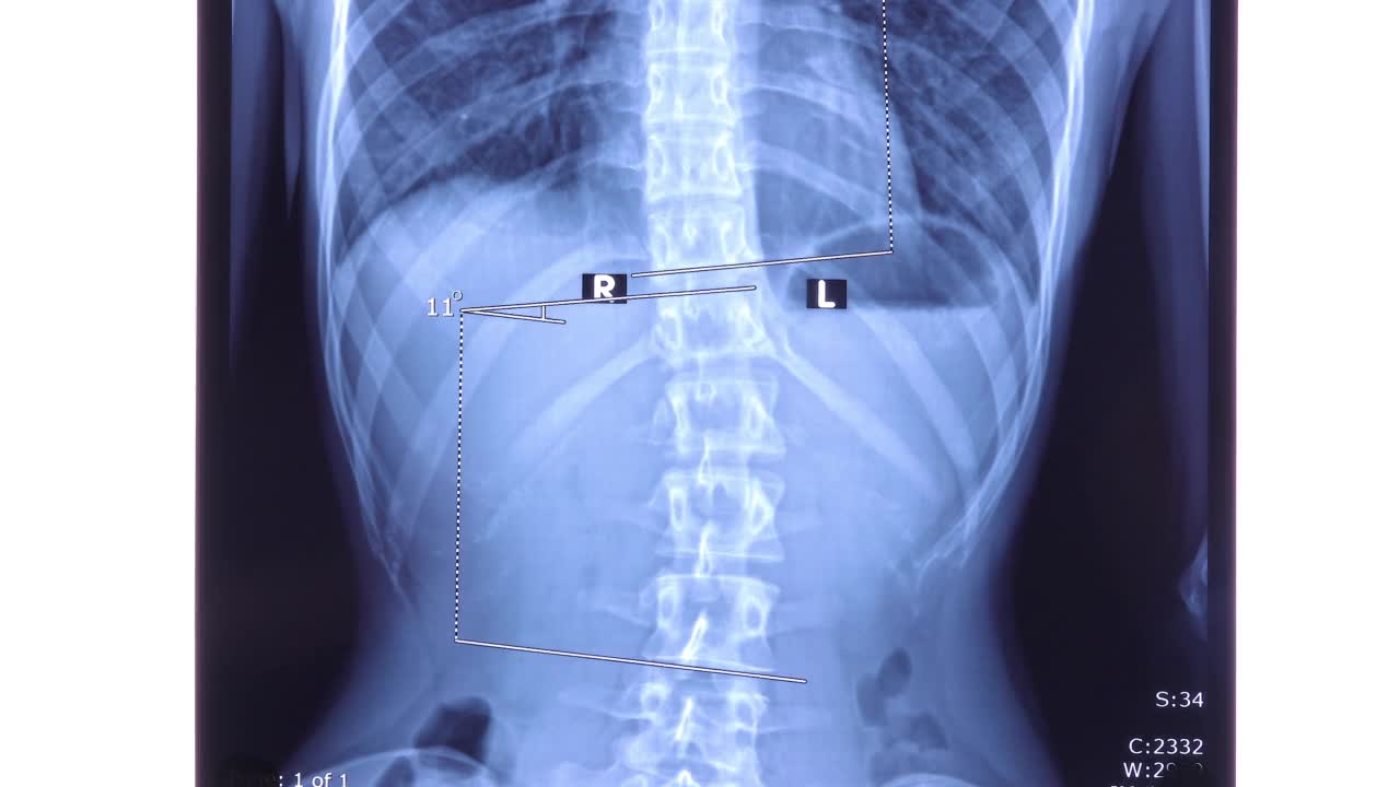 X光片显示腰椎侧弯视频素材