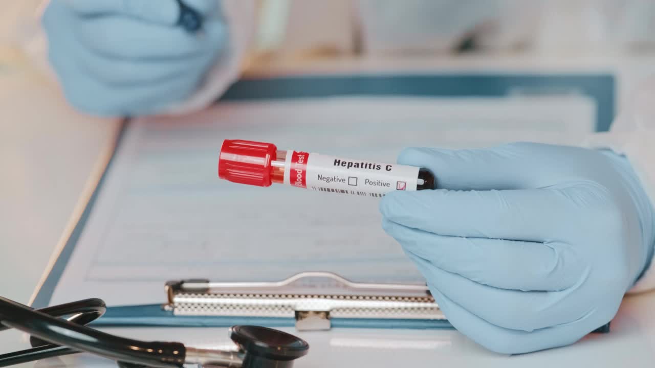 医生手里拿着丙型肝炎病毒阳性的血样视频素材