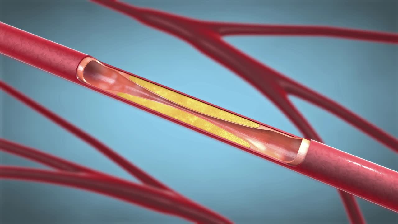 血管成形术中支持血管内血液循环的支架植入。3d插图视频购买