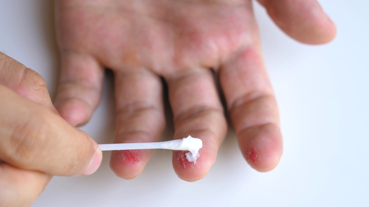 男性手臂用棉签将药膏涂在受伤疼痛的手指上。一名男子在手上划伤的皮肤、伤口上涂抹愈合膏。医生治疗成人病人，红肿，皮肤疤痕视频素材