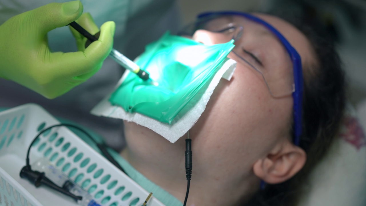 牙科助理的手离开紫外线固化光和不认识的牙医插入填补牙齿。在医院牙科椅上治疗病人的白人职业妇女。缓慢的运动。视频素材