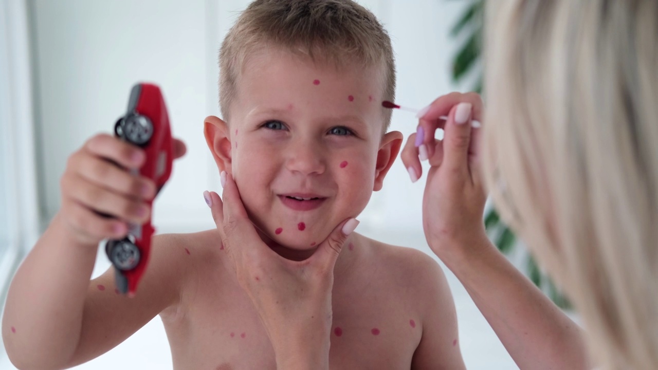 用药膏在儿童皮肤上治疗水痘、水痘溃疡。妈妈用红药给孩子敷脸。视频下载
