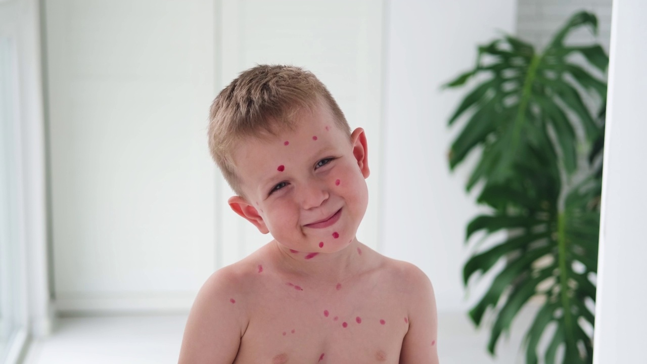 画的是一个快乐的男孩，脸上起了水痘疹子。在孩子的皮肤上用红色治愈霜治疗水痘。视频下载
