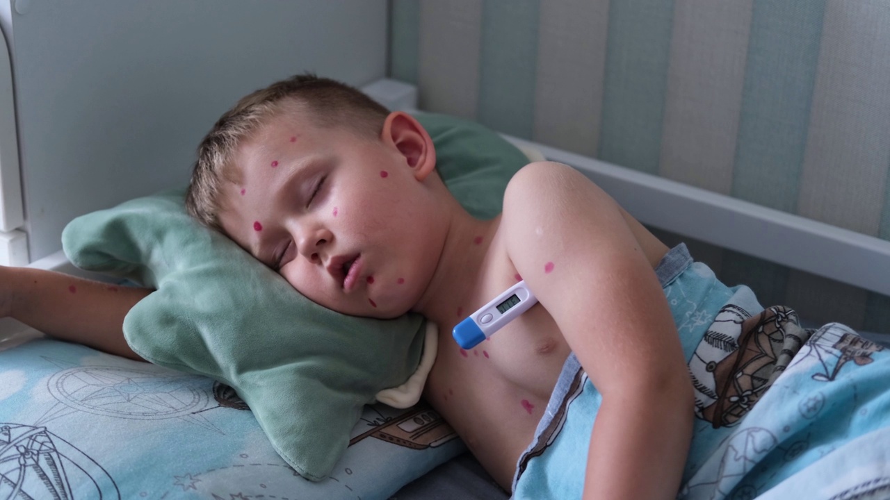 生病的小男孩一边睡觉一边测量体温，脸上起了水痘疹子。儿童的水痘是用一种红色的治愈药膏涂在孩子的皮肤上治疗的。视频下载