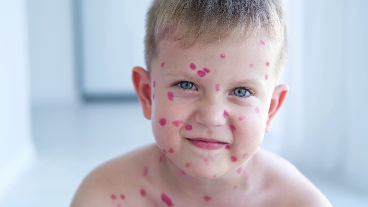 一个悲伤的男孩，脸上起了水痘疹子。在孩子的皮肤上用红色治愈霜治疗水痘。视频下载