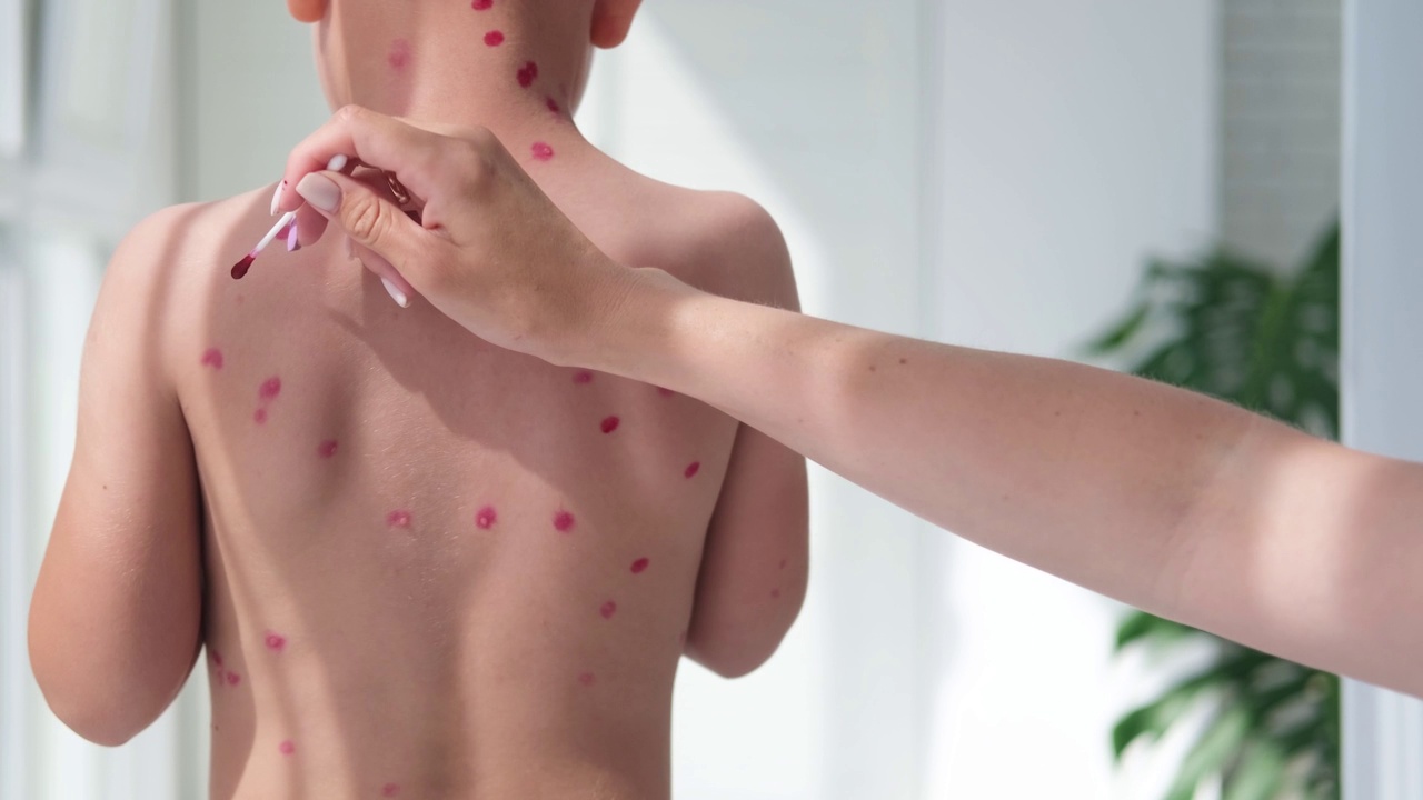 用药膏在儿童皮肤上治疗水痘、水痘溃疡。妈妈用红药给孩子治背。视频下载