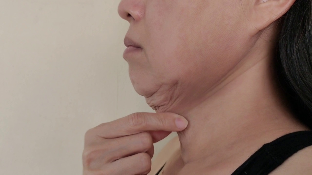 松弛的脂肪，下垂和皱纹的脂肪团在脖子下面视频素材
