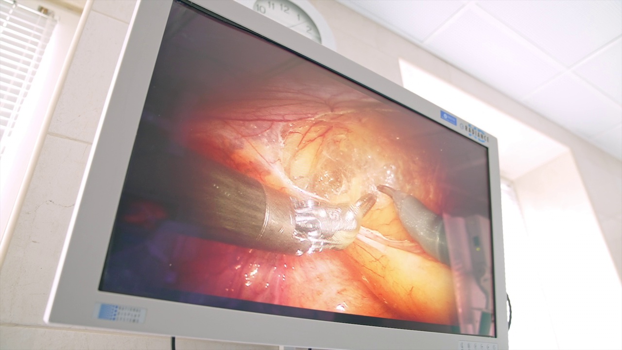 精密精密的机械臂操作病人。手术室的大屏幕显示手术过程。关闭了。视频下载