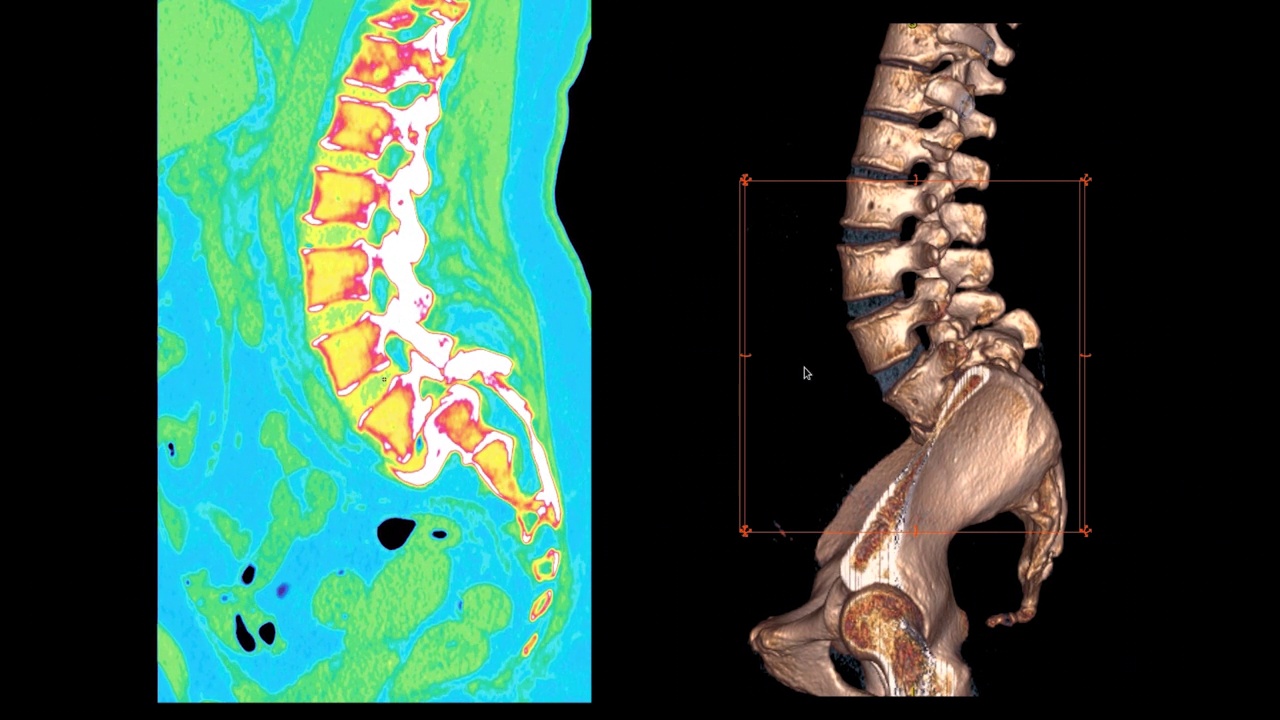 腰椎CT扫描对腰痛疾病的诊断价值视频素材