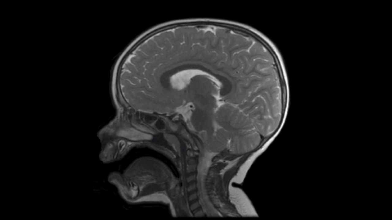儿童头部的核磁共振扫描序列视频下载