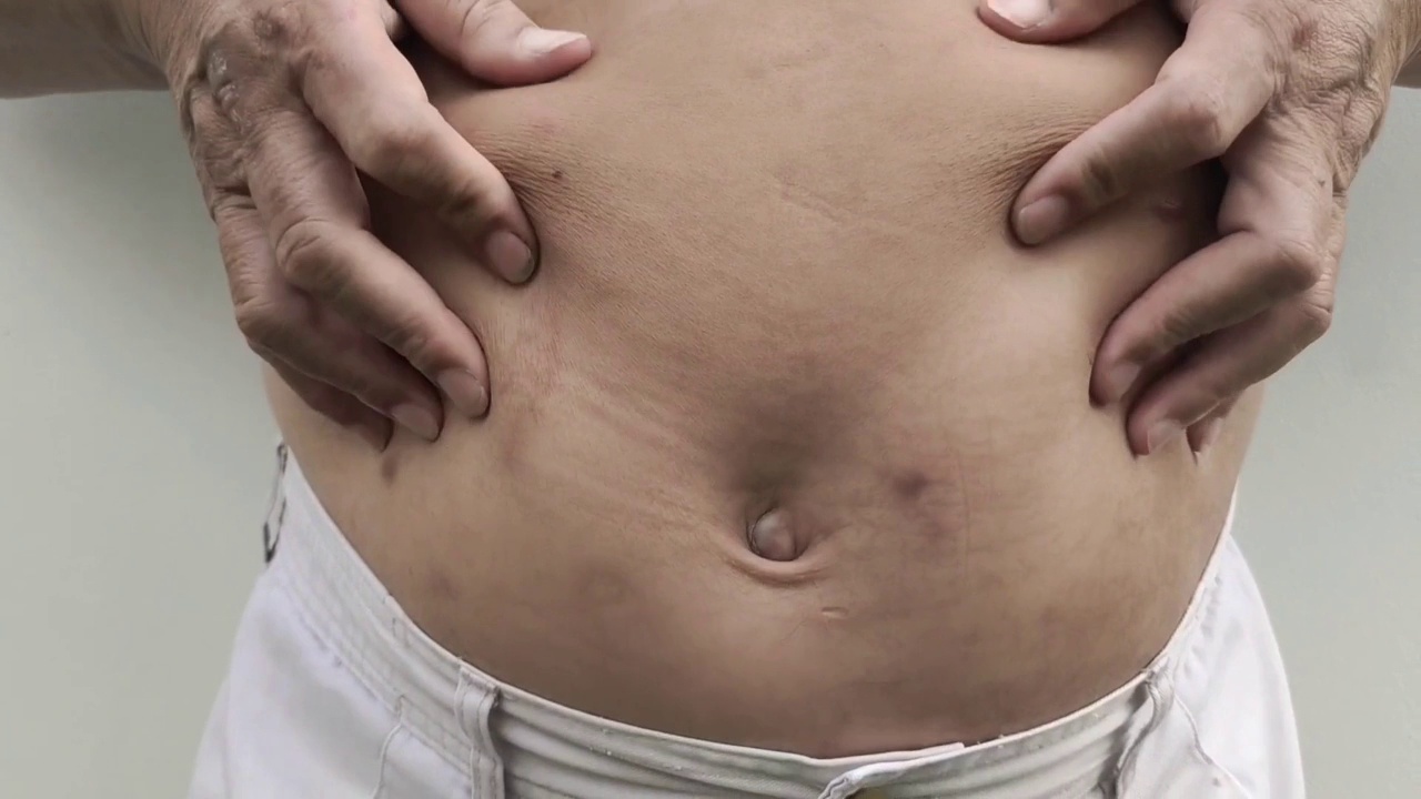 男性腰部有脂肪团，腹部有脂肪团。视频素材